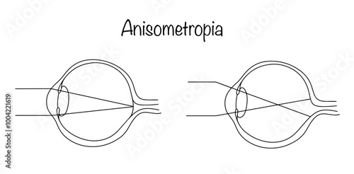 Anisometropia