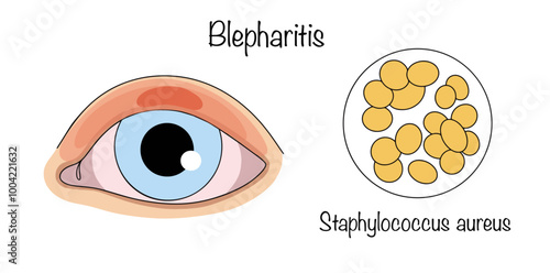 Blepharitis