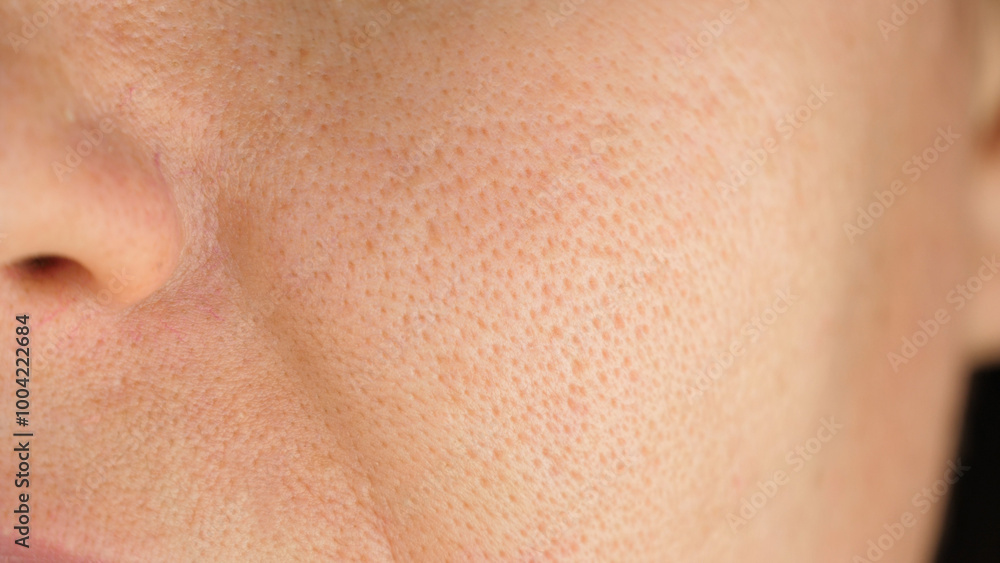 Close-up of facial skin with enlarged pores. close-up of a woman face. problem skin treatment concept, cosmetic procedures for skin treatment. Close-up of facial skin with enlarged pores. close-up of a woman face. problem skin treatment concept, cosmetic procedures for skin treatment.