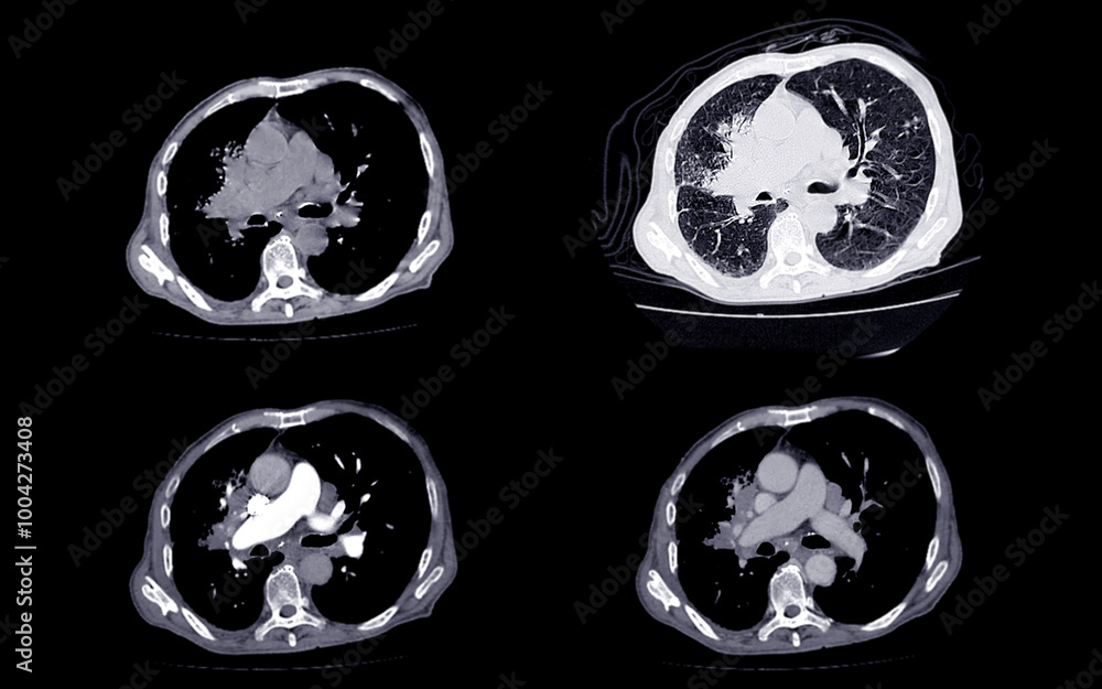 Obraz premium A CT scan of the chest showing multiple cross-sectional views, highlighting the lungs, heart, and major vessels, used for medical analysis of thoracic structures.