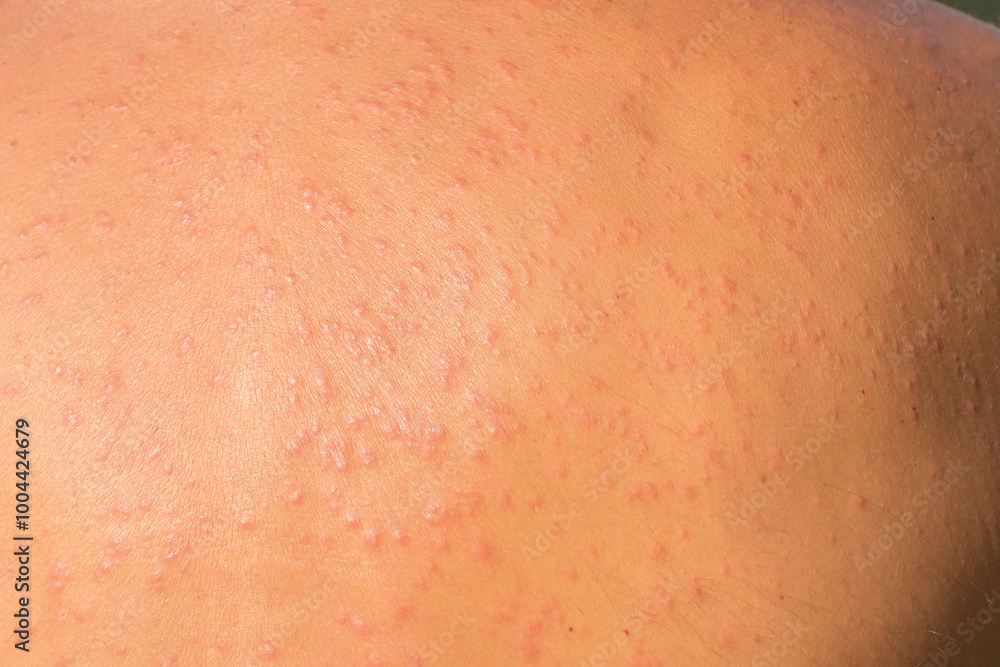 Sun allergy. Close-up of a man's back with an allergic reaction to the sun. The red tanned back shows many pimples and rashes. Dermatology and sun protection concept. Sun allergy. Close-up of a man's back with an allergic reaction to the sun. The red tanned back shows many pimples and rashes. Dermatology and sun protection concept.
