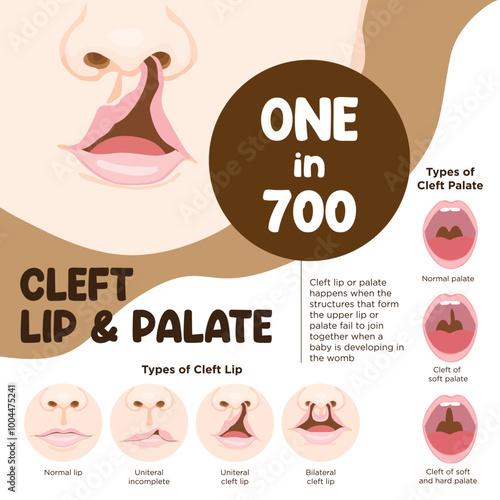 Vector illustration of cleft lip and palate diagram poster