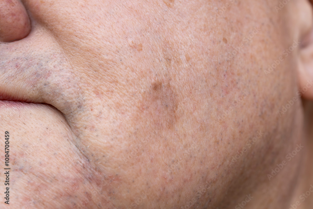 Result after two weeks of cryotherapy on Seborrheic Keratosis (Seborrhoeic wart, Basal cell papilloma, Senile wart) Skin Growth on man's cheek Result after two weeks of cryotherapy on Seborrheic Keratosis (Seborrhoeic wart, Basal cell papilloma, Senile wart) Skin Growth on man's cheek
