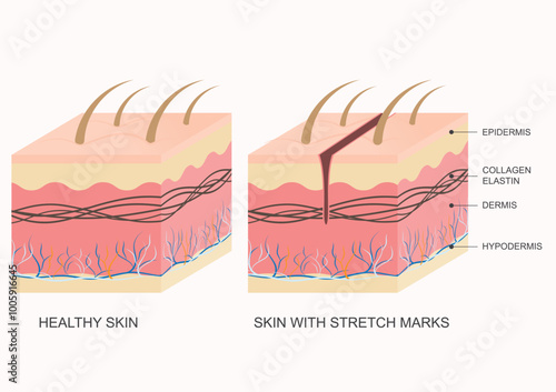 Stretch mark is a type of scar.