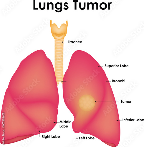 Lungs Tumor Trachea Superior Lobe Bronchi Tumor Inferior Lobe Middle Lobe Left And Right Lobe