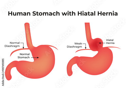 Human Stomach With Hiatal Hernia Normal Diaphragm Normal Stomach Weak Diaphragm Hiatal Hernia  Science Vector Illustration