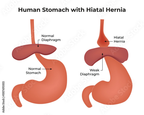 Human Stomach With Hiatal Hernia Normal Diaphragm Normal Stomach Weak Diaphragm Hiatal Hernia  Science Vector Illustration