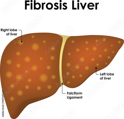 Fibrosis Liver Anatomy Right And Left Lobe of Liver Falciform Ligament Vector Illustration
