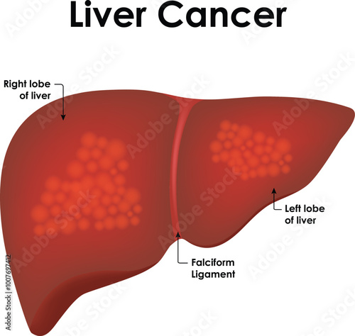 Liver Cancer Anatomy Right & Left Lobe of Liver Falciform Ligament Vector Illustration