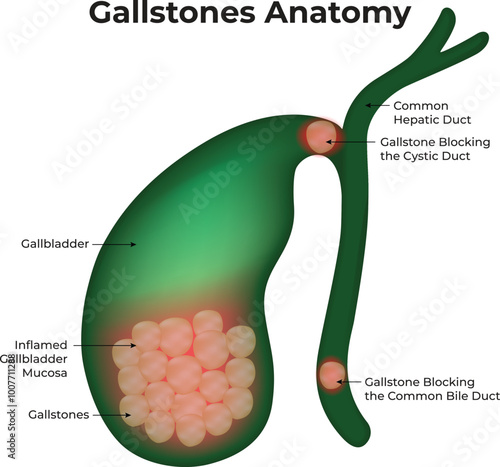 Gallstones Anatomy Gallbladder Hepatic Duct Mucosa Science Vector Illustration
