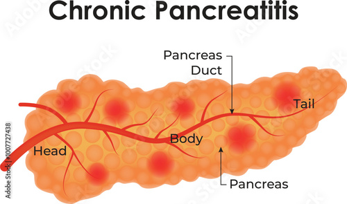 Chronic Pancreatitis Healthy Pancreas Head Body Pancreas Pancreas Duct Science Vector Illustration
