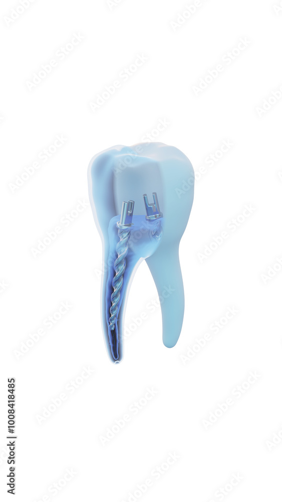 Dental steel post inside molar teeth, Xray view. Dental endodontic treatment 3D render illustration Dental steel post inside molar teeth, Xray view. Dental endodontic treatment 3D render illustration