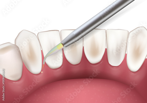 Dental laser with healthy white teeth. Laser dentistry instrument. Dental treatment at the dentist