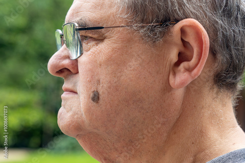 Photos Brown Seborrheic Keratosis (Seborrhoeic wart, Basal cell papilloma, Senile wart)