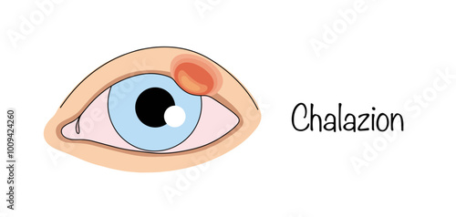 Chalazion