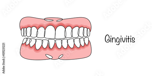 Gingivitis