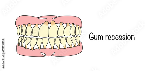 Gum recession photo