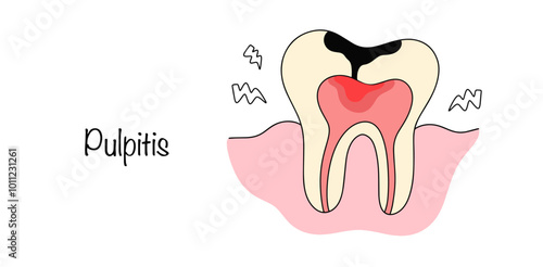 Pulpitis