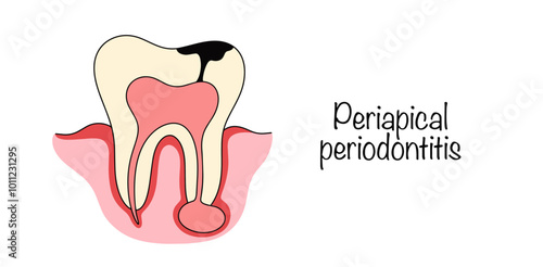 Periapical periodontitis