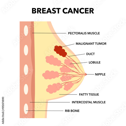 Breast cancer medical vector diagram with a cross-section of female breast anatomical structure and illustration of malignant breast tumor affected by cancer.