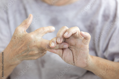 Fényképezés Senior woman suffering from Rheumatoid Arthritis,resembling Rheumatism,Rheumatoi