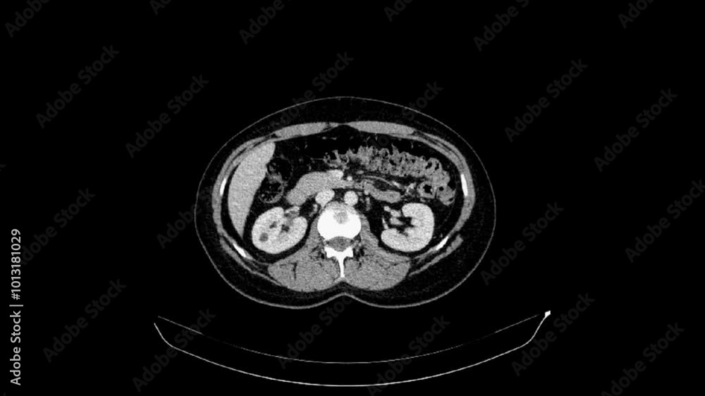 CT of the abdomen and pelvis with intravenous contrast of a 40-year-old ...