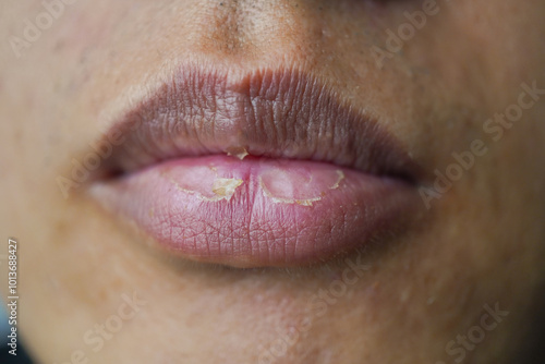 Close up photo of A man suffering from chapped lips. Concept for skincare and oral disease.