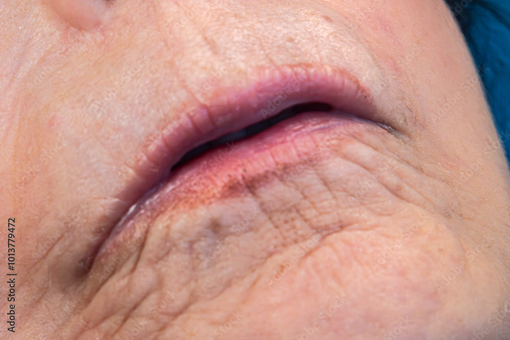 Obraz premium Medical themes: Female patient with scleroderma