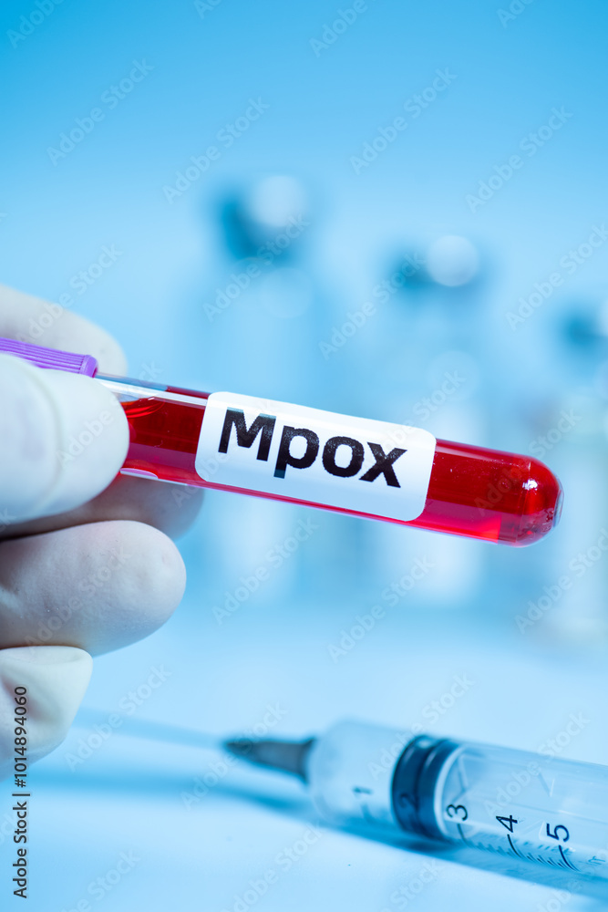 Fototapeta premium Blood collection tubes Mpox test positive results,WHO to rename monkeypox as ‘Mpox’