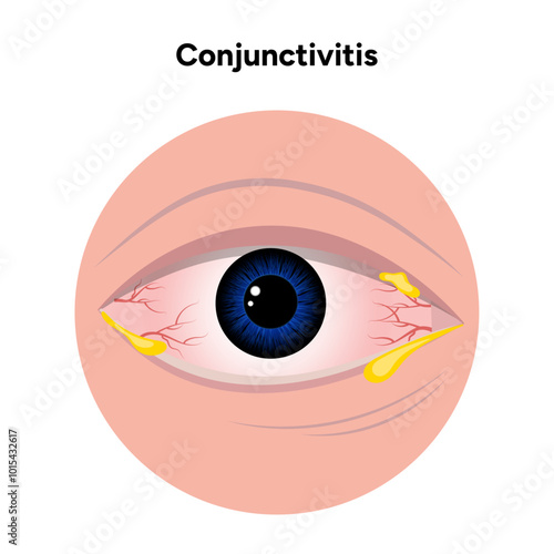 Bacterial conjunctivitis. Ophthalmology diseases conjunctiva 