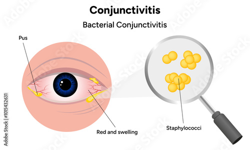 Bacterial conjunctivitis. Ophthalmology diseases conjunctiva 