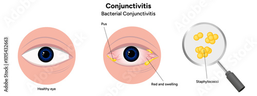 Bacterial conjunctivitis. Ophthalmology diseases conjunctiva 