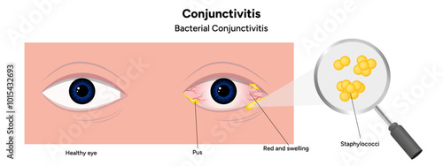 Bacterial conjunctivitis. Ophthalmology diseases conjunctiva 