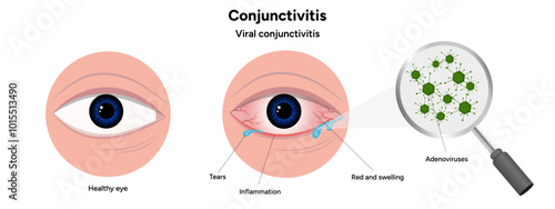 Viral conjunctivitis. Ophthalmology diseases conjunctiva