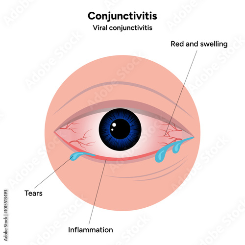 Viral conjunctivitis. Ophthalmology diseases conjunctiva