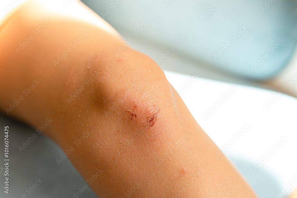 Fototapeta premium Healing process of a scraped knee showing a wound on a child's elbow in soft, natural light indoors during the afternoon. Close-up