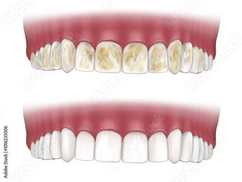 Deep Teeth Cleaning. Before and After. Teeth whitening concept. Debridement dental. Dental plaque tartar