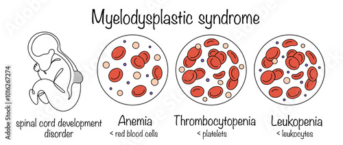 Myelodysplastic syndrome