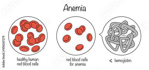 Anemia