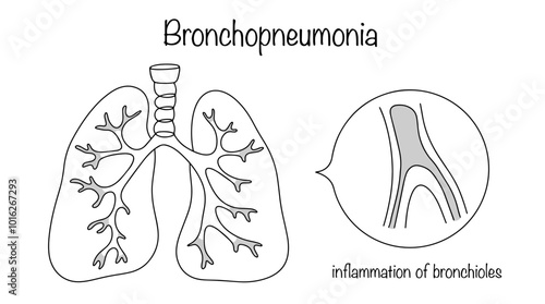 Bronchopneumonia