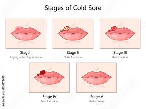 cold sore, from the initial tingling sensation to blister formation, ulcer eruption, crusting, and healing diagram hand drawn schematic vector illustration. Medical science educational illustration