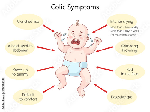 crying baby with common colic symptoms, clenched fists, swollen abdomen, excessive gas, difficulty to comfort diagram hand drawn schematic vector illustration. Medical science educational illustration