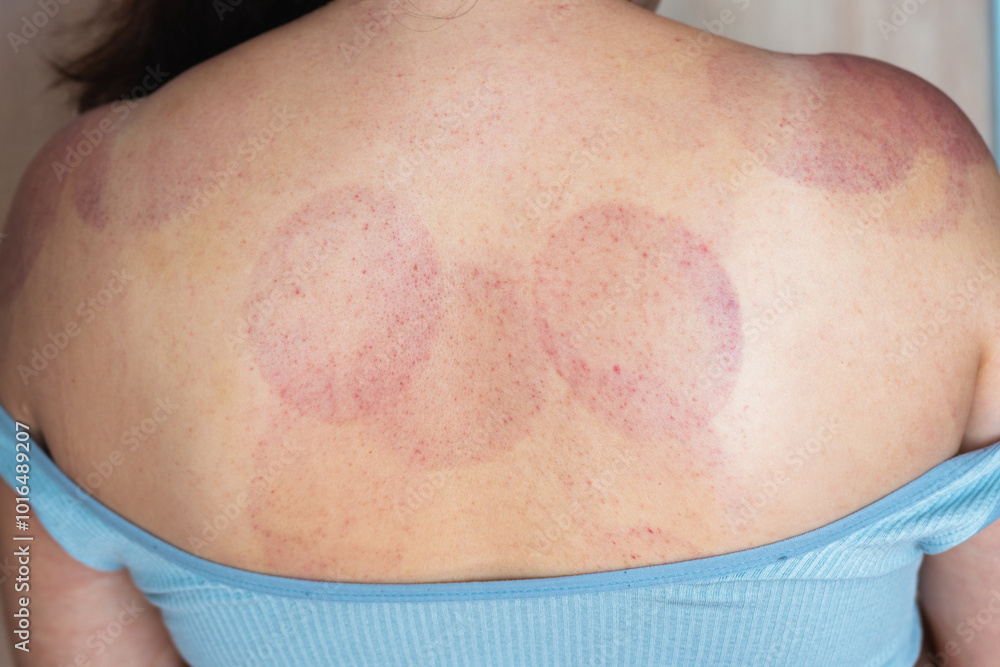 Fototapeta premium Hematomas on a woman's shoulders and back after a cupping massage procedure
