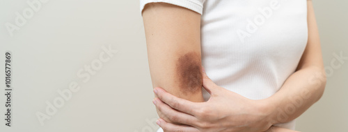 Принти на полотні Close up of stain bruise wound on arm, contusion asian young woman, girl an acci