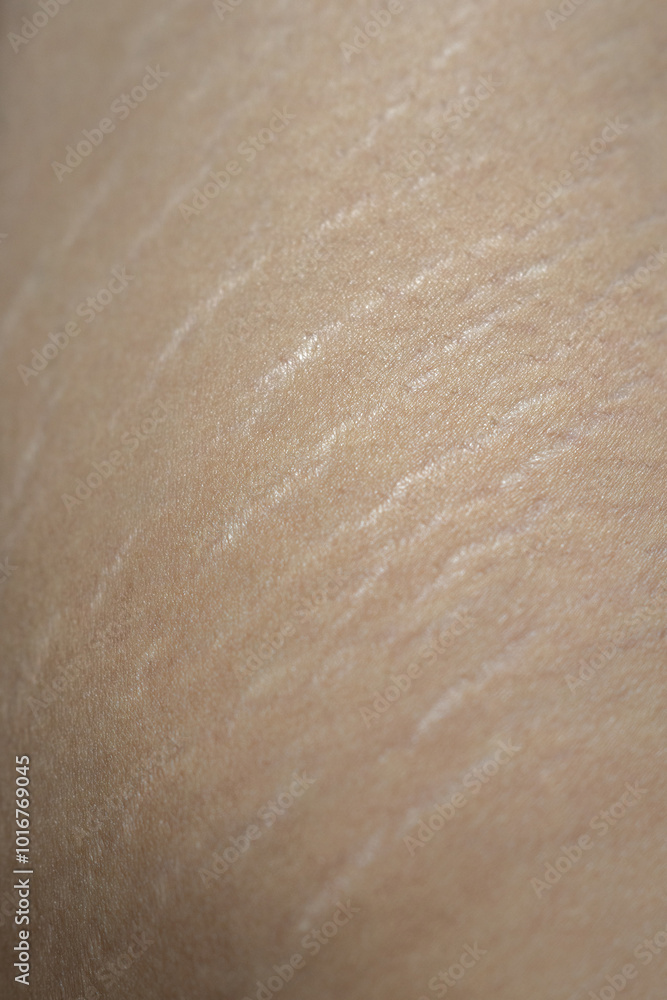Fototapeta premium Stretch Marks on Groin Area – Skin Texture and Health Concept