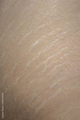 Stretch Marks on Groin Area – Skin Texture and Health Concept