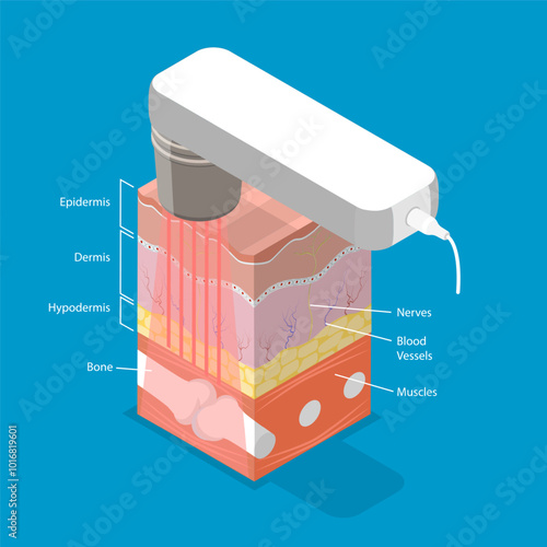 3D Isometric Flat Vector Illustration of Laser Therapy, Alleviating Patient Pain And Stimulate Healing
