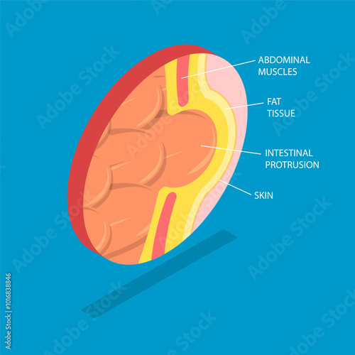 3D Isometric Flat Vector Illustration of Hernia, Health Issues Related To The Abdomen And Intestines
