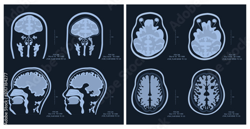 MRI image of a human brain showing all the major manifestations of multiple sclerosis