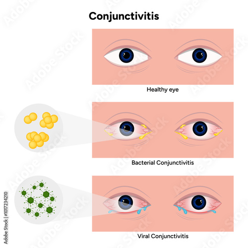 Viral and bacterial conjunctivitis. Ophthalmology diseases